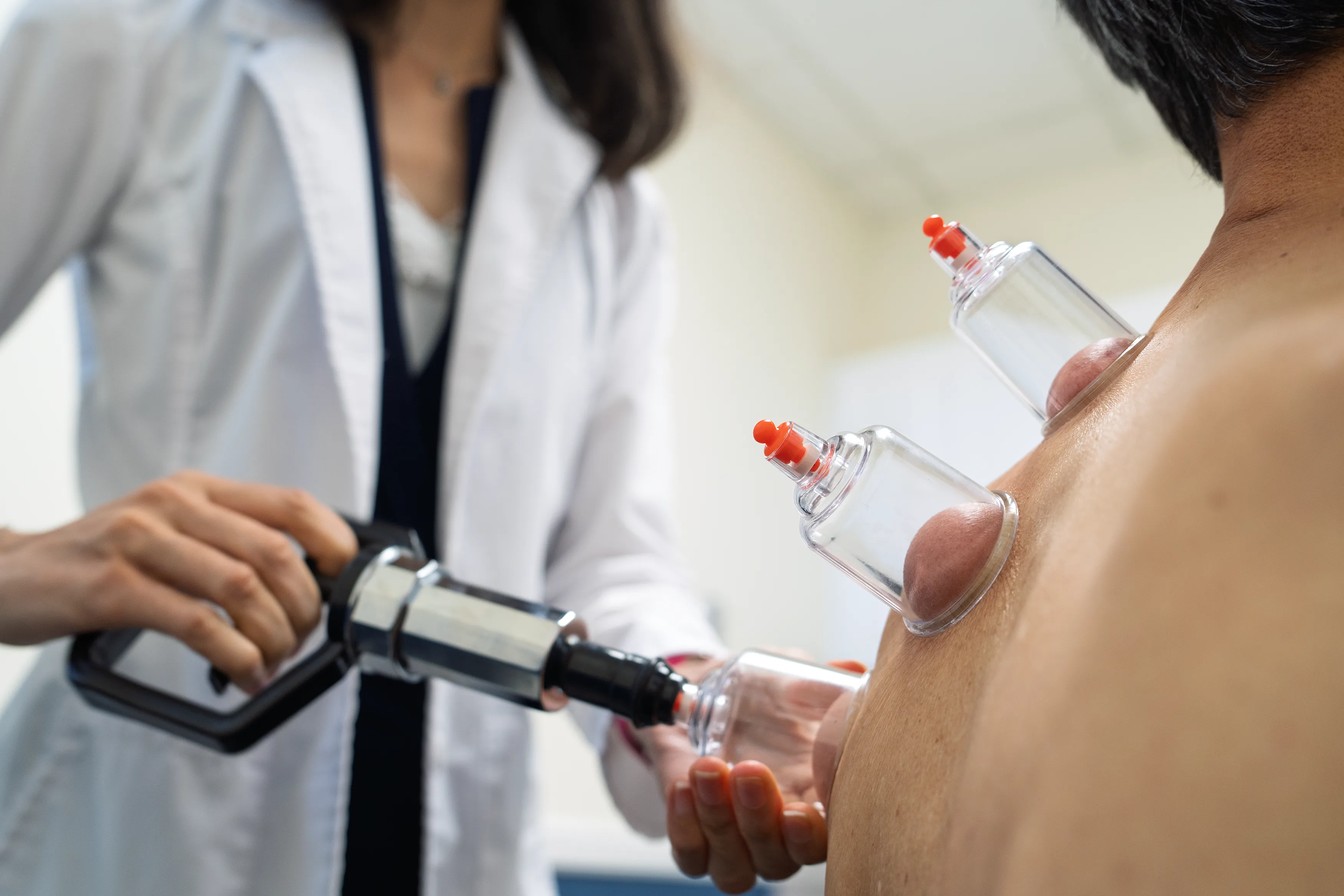 Cupping therapy being performed at Holistic HealthPlus in Warren, NJ