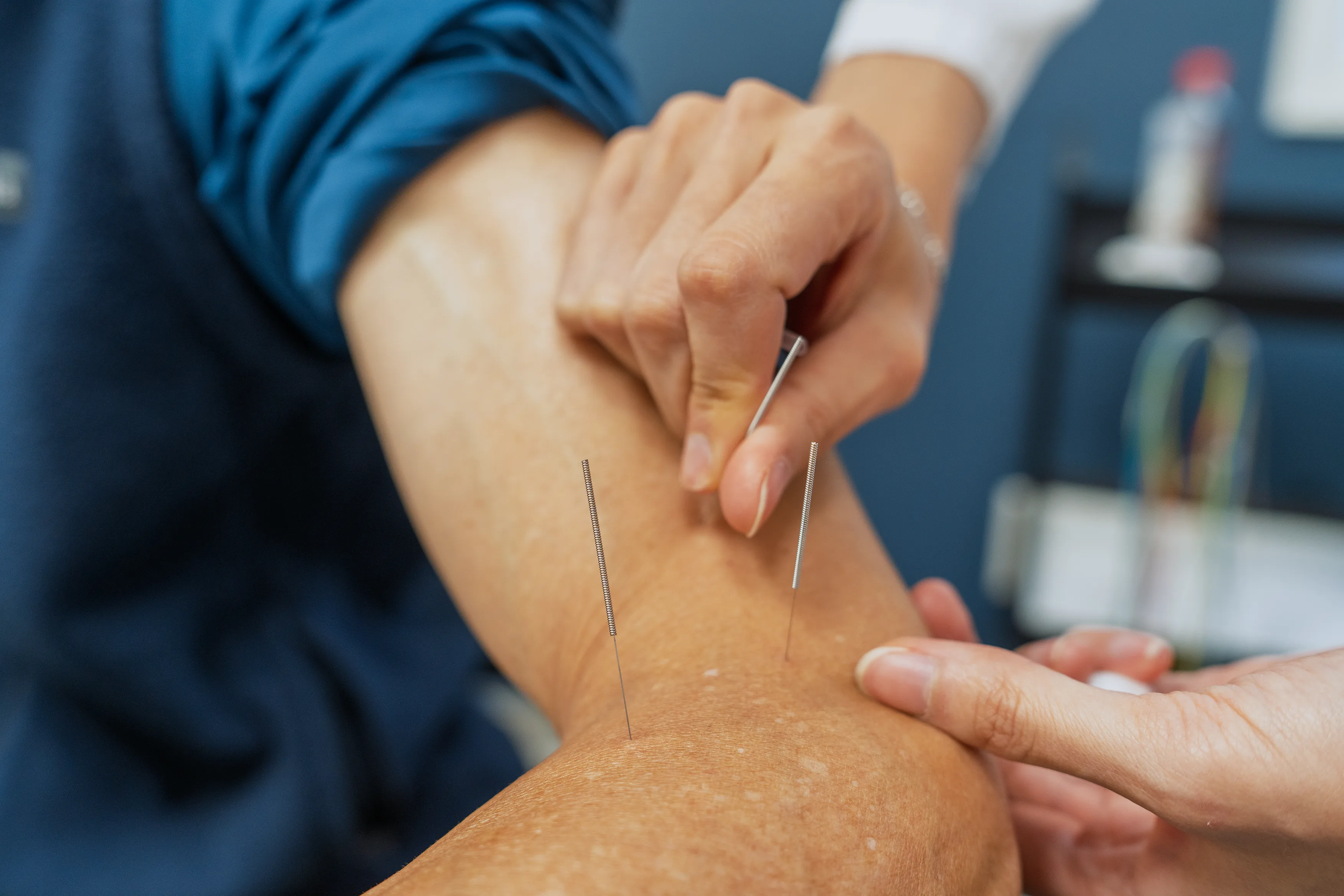 Acupuncture needle placement on a patient's arm at Holistic HealthPlus